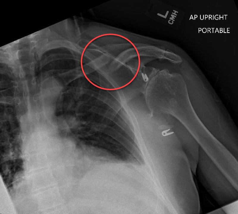 Jim Clavicle Break 2 circled 31-Aug-2023.jpg