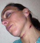 2013_dt_friction_burn.jpg