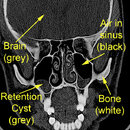 sinus.jpg