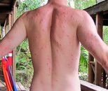 Sandflea_Bites_Roatan1.jpg