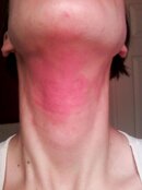 neck-rash-after.jpg