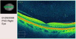 PVD Right Eye First View.jpg