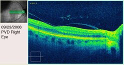 PVD Right Eye Second View.jpg