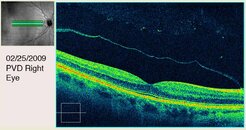 PVD Right Eye Fourth View.jpg