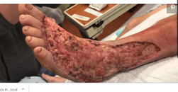 flesh eating bacteria.png
