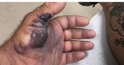 flesh-eating-bacteria-fishing.png