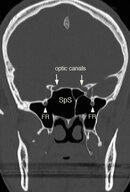 Sphenoid2.jpg