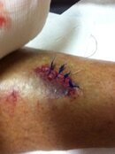 Hank's Roatan Stitches 2.JPG