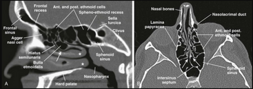 Anatomy of sinus cavities.png