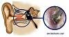 117198d1330433161t-ear-infections-constant-problem-swimmers-ear-combo.jpg