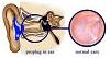 117200d1330433869t-ear-infections-constant-problem-proplug-ear-combo.jpg
