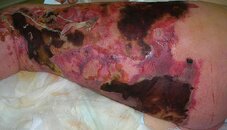 800px-Necrotizing_fasciitis_left_leg.JPEG