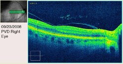 PVD 2 Right Eye Second View.jpg