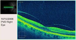 PVD 3 Right Eye Third View.jpg