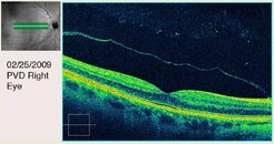 PVD 4 Right Eye Fourth View.jpg