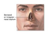 deviated-septum.jpg