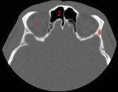 sinus_axial_1_fscopie_fs.jpg