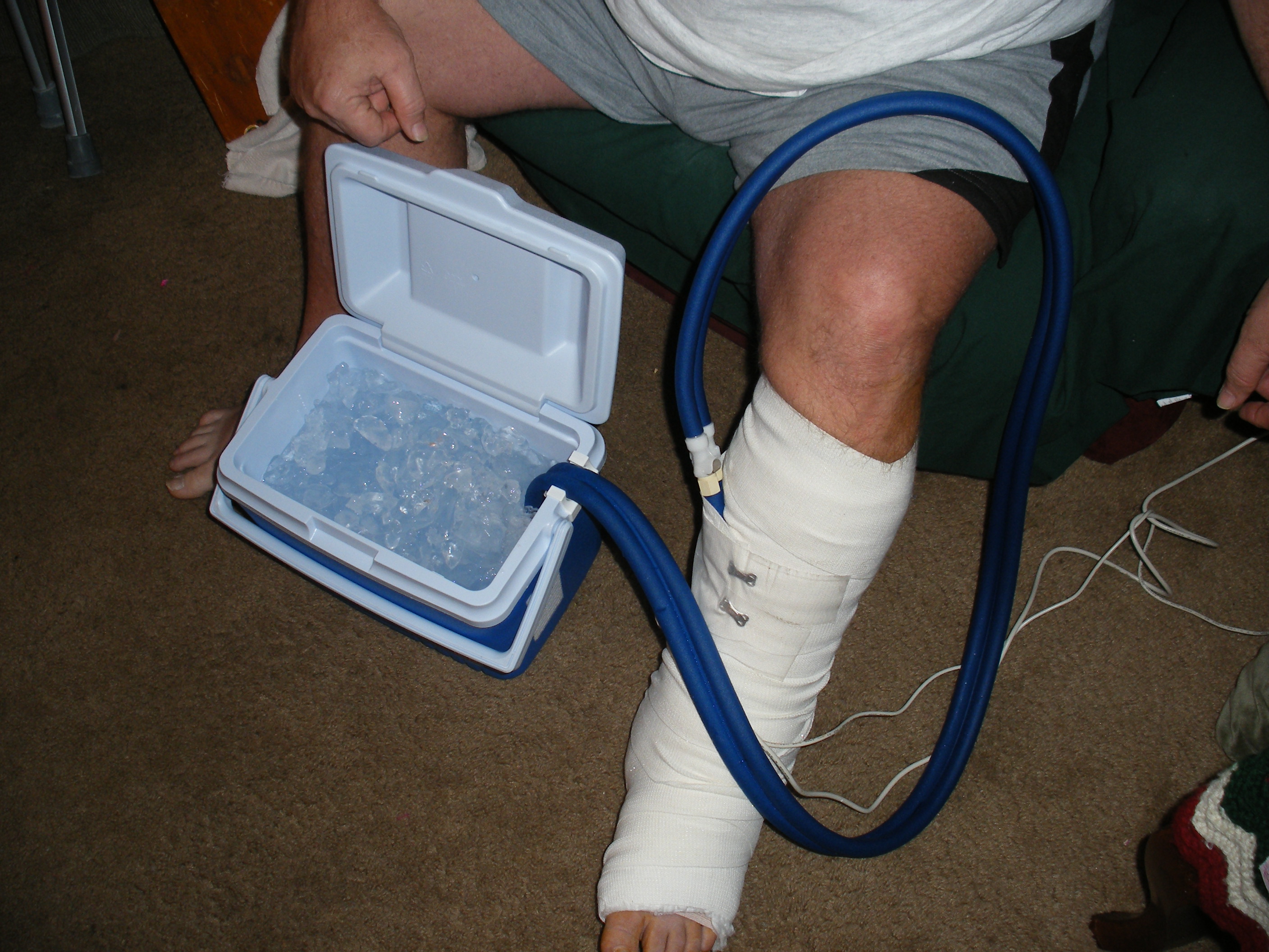 Healing after Achilles Surgery