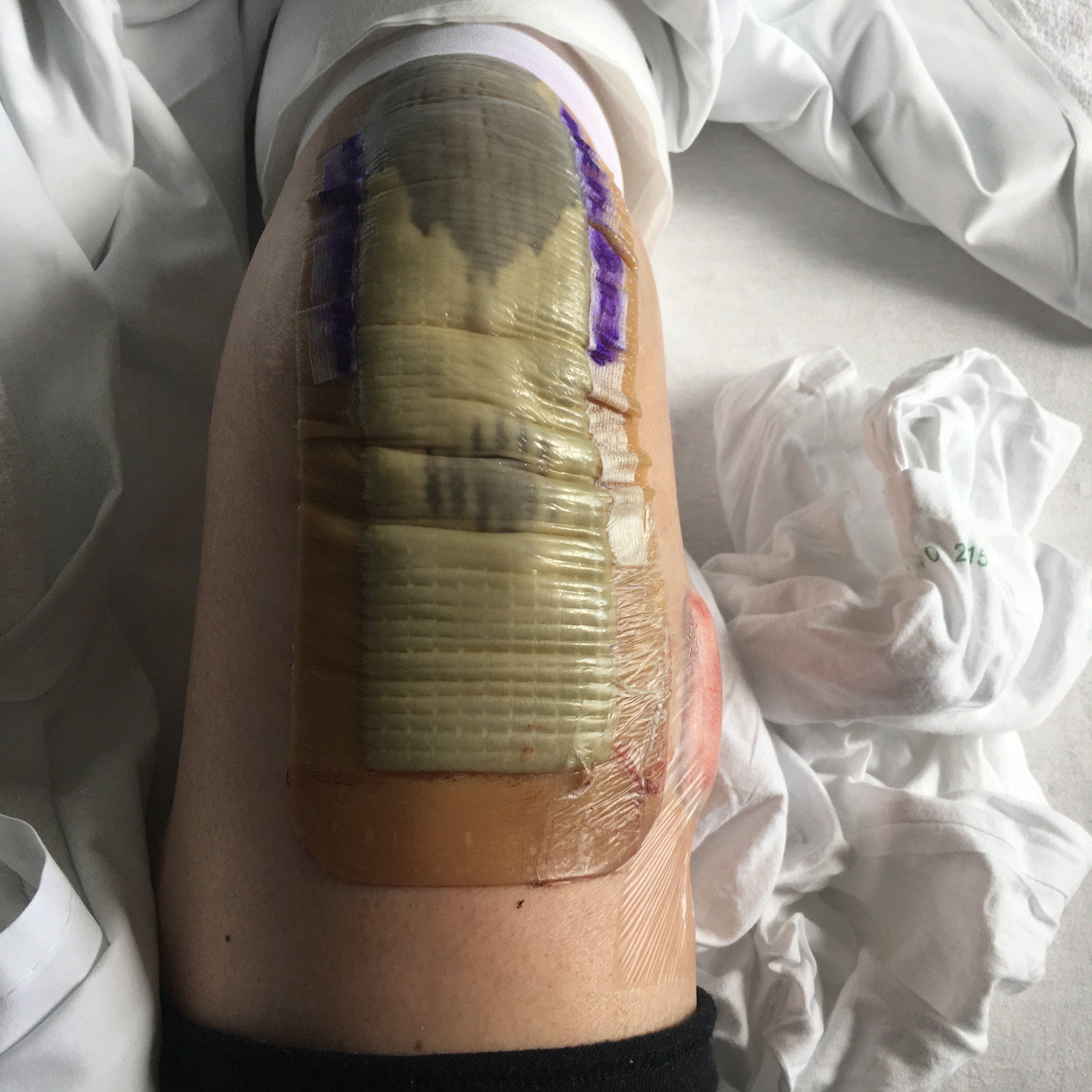 Knee Op 1